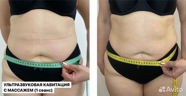 Косметолог - Кавитация, настоящий жиротоп