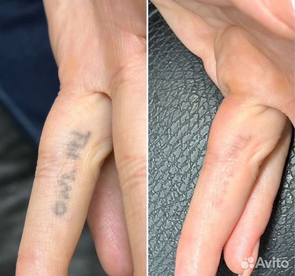 Удаление тату и татуажа на современном лазере