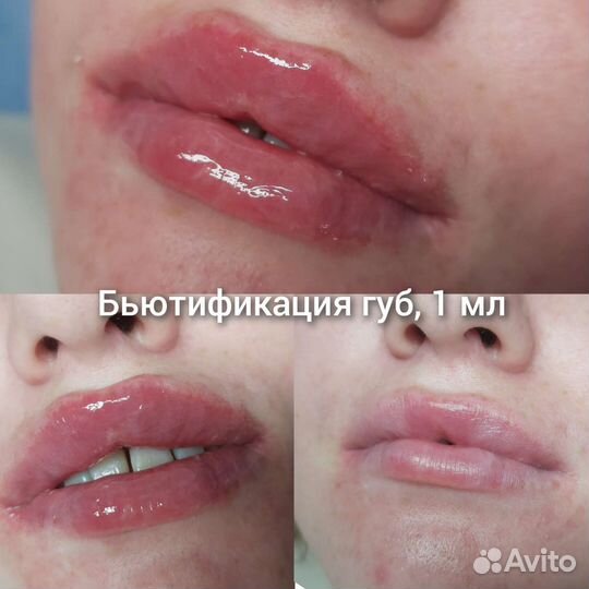 Бьютификация губ