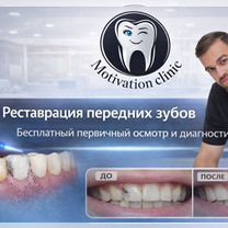 Реставрация передних зубов, Москва