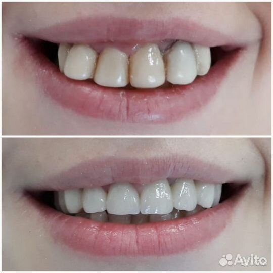 Съемные Несъемные Зубные протезы Виниры