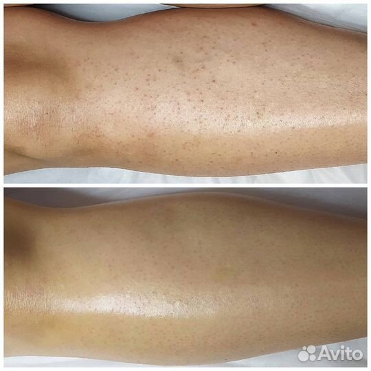 Шугаринг/Гелинг