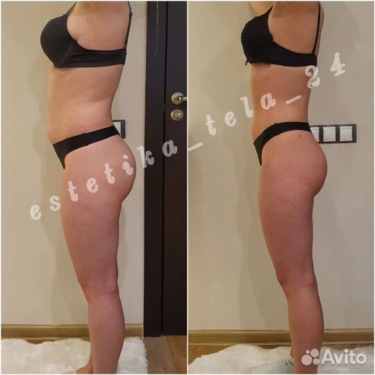 LPG массаж, аппаратная коррекция фигуры