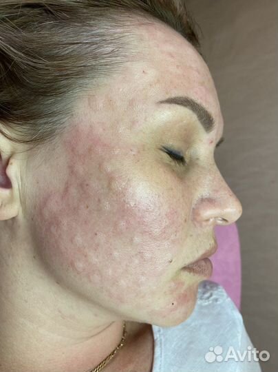 Обучение косметологов.Увеличение губ