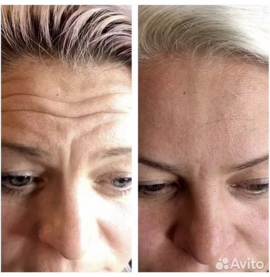 Требуются модели на ботокс