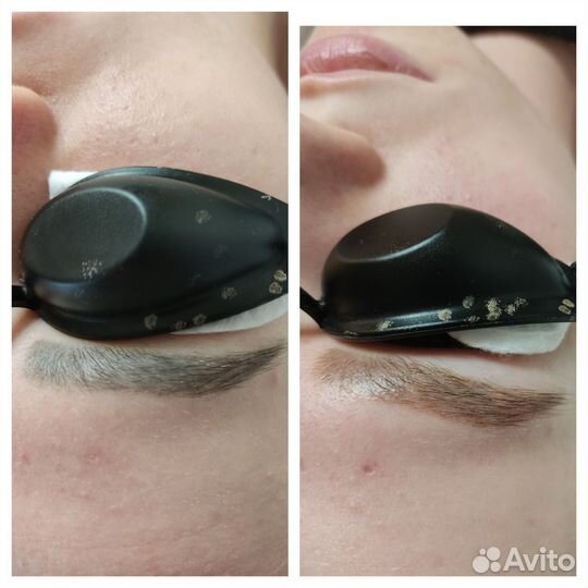 Лазерное удаление тату и татуажа