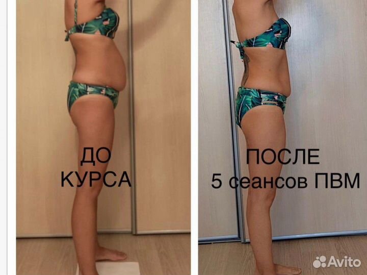 Гидромассаж (подводный вакуумный массаж)