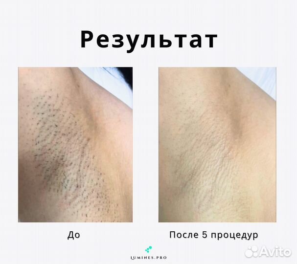 Аппарат для эпиляции люминес Макс-Ван 1200в