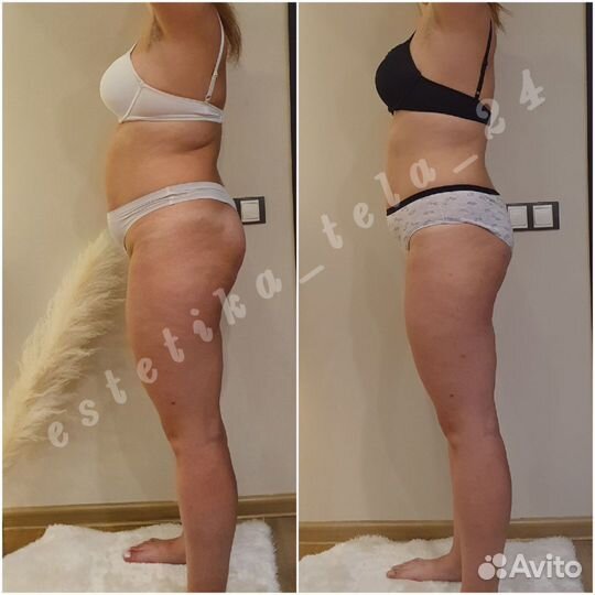 LPG массаж, аппаратная коррекция фигуры