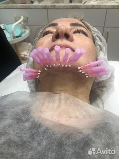 Тредлифтинг лица