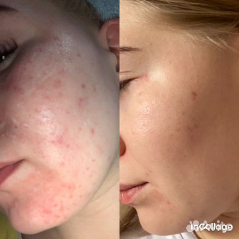 Пилинг для лица