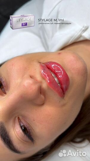 Модель на увеличение губ