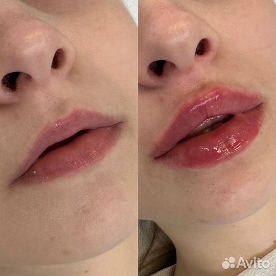 Увеличение губ