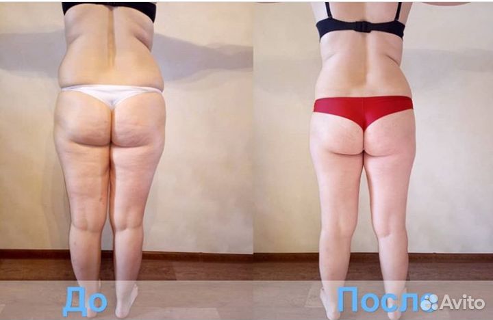 Массаж антицеллюлитный,мадейратерапия,классический