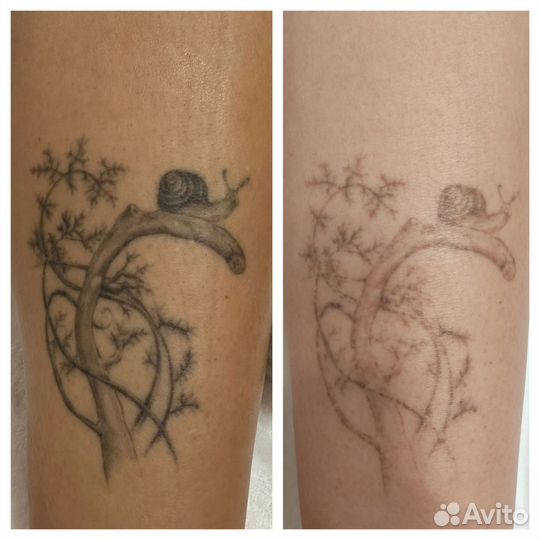 Лазерное удаление тату и татуажа