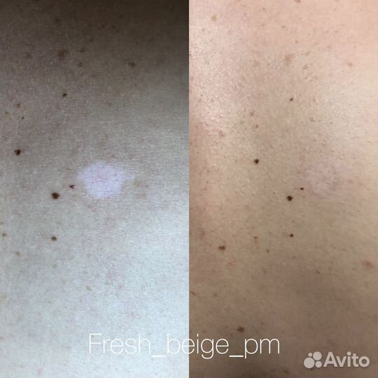 Татуаж растяжек и шрамов