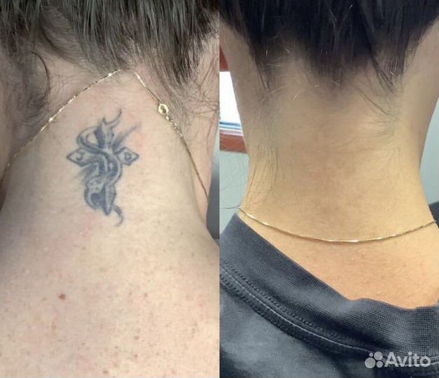 Лазерное удаление татуажа и тату