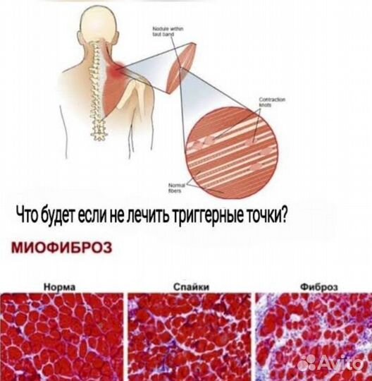 Миофасциальный массаж, миопрессура