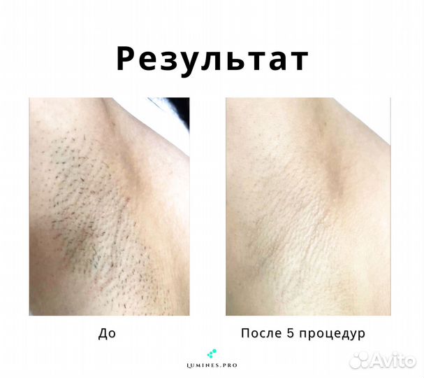 Диодный лазер для эпиляции люминес Макс’Ван 1200W