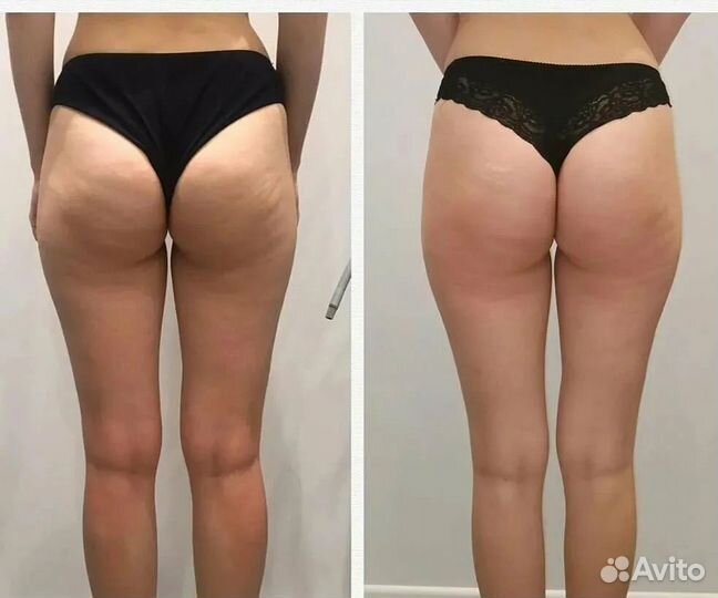 Аппаратный антицеллюлитный массаж