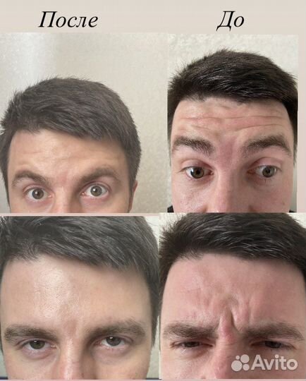 Мезотерапия волос