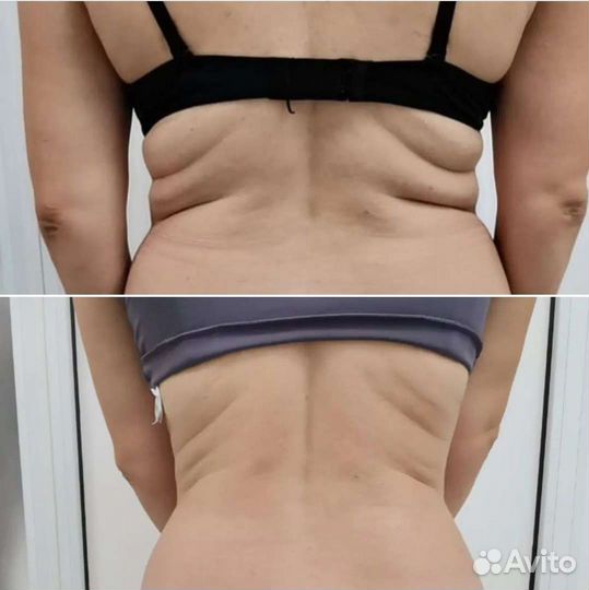 Вакуумный аппаратный массаж, обертывание