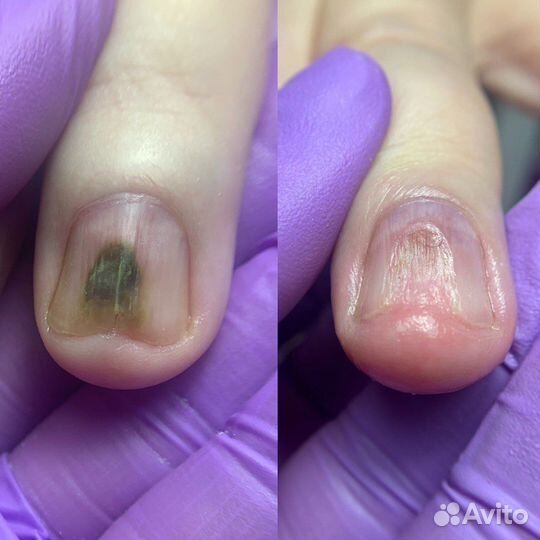 Подолог педикюр