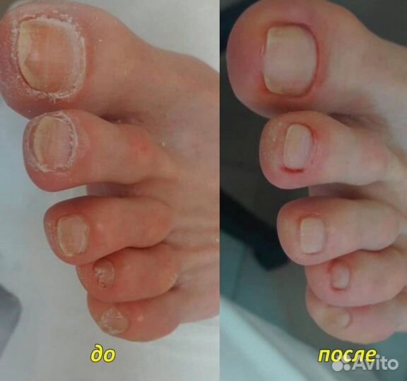 Медицинский педикюр вросший ноготь