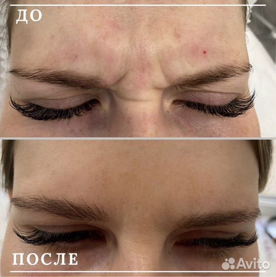 Ботулинотерапия