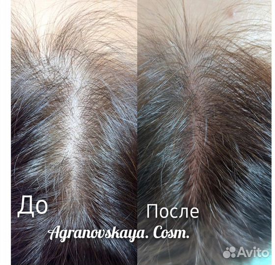 Холодная плазма Тольятти