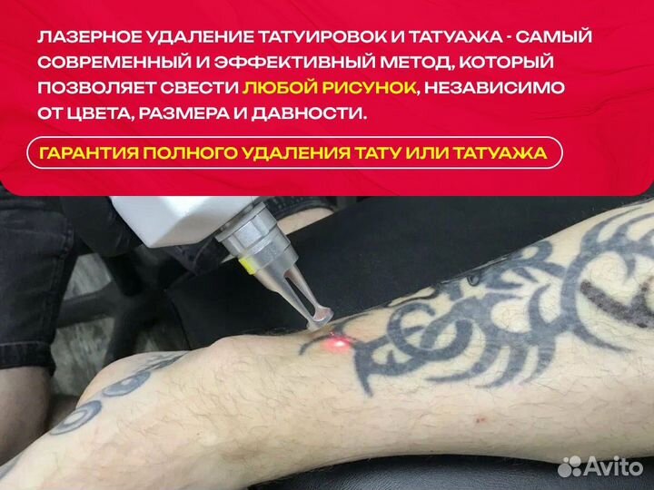 Лазерное удаление татуировки, татуаж, перманент