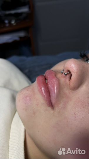 Увеличение губ