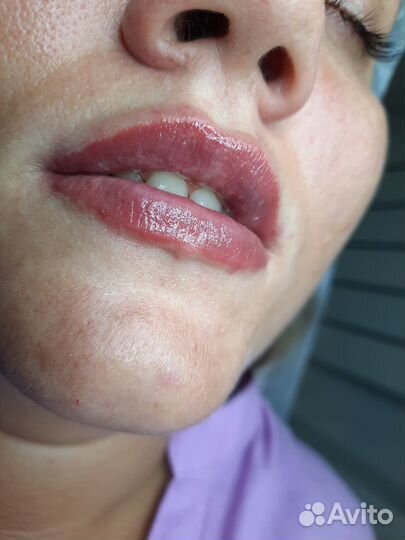 Контурная пластика губ