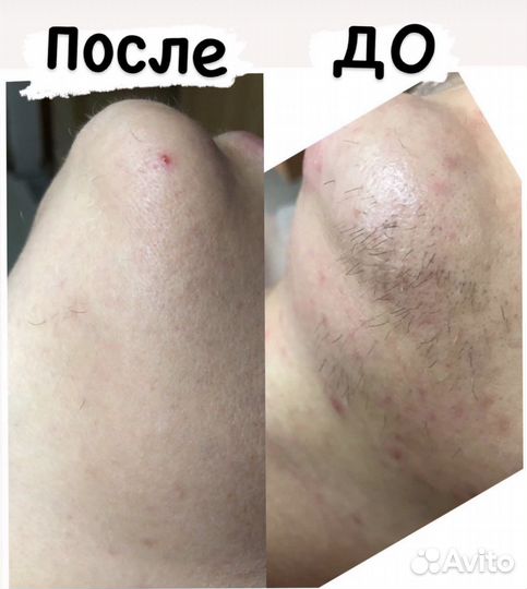 Электроэпиляция