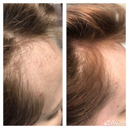 Мезотерапия для кожи головы и волос