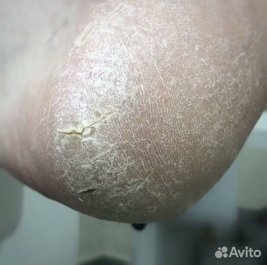 Подолог, коррекция вросших ногтей, педикюр