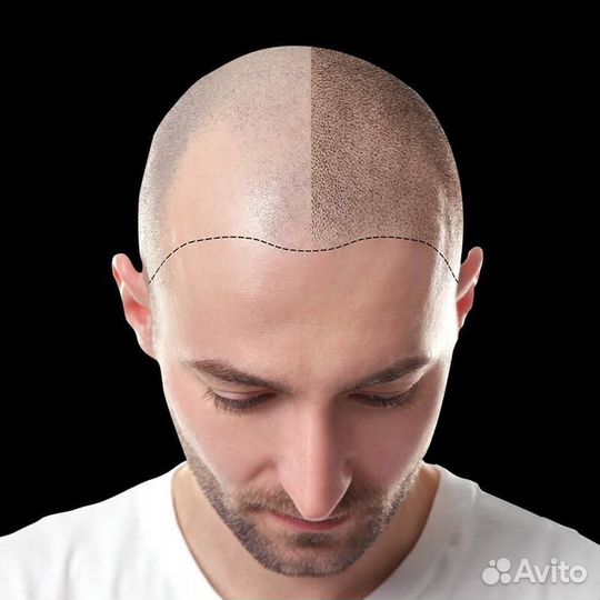 Пересадка волос в Казани