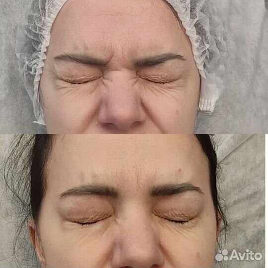 Модель на ботокс лица