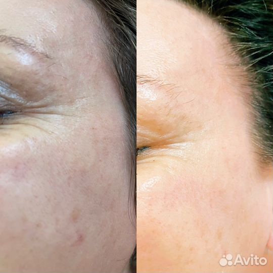 Испанский хиропластический массаж лица