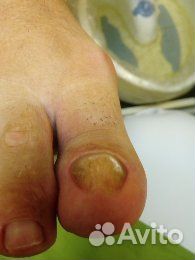 Медицинский педикюр, подолог