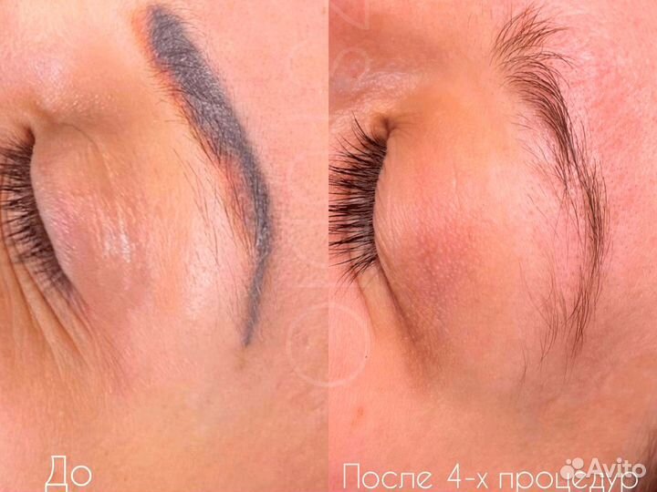 Лазерное удаление татуажа Удалить татуаж