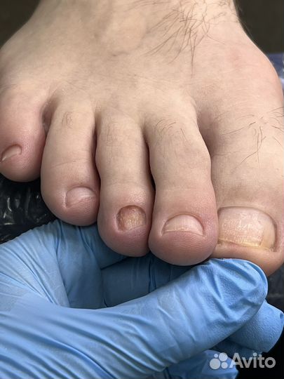 Подолог, медицинский педикюр, педикюр