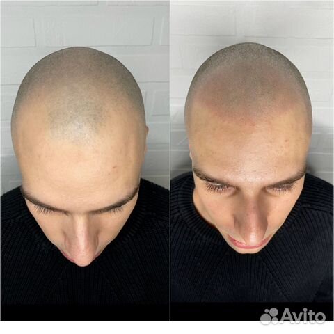 Трихопигментация головы, метод SMP