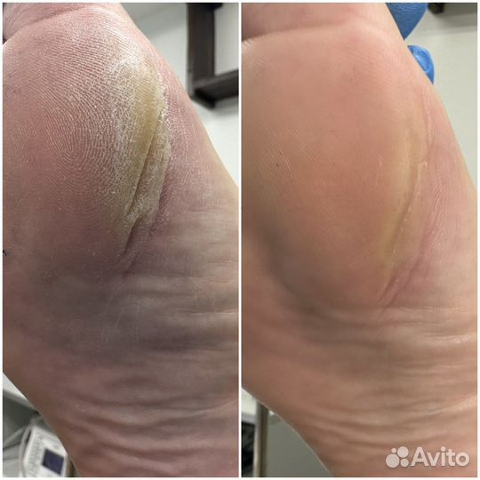 Педикюр подолог