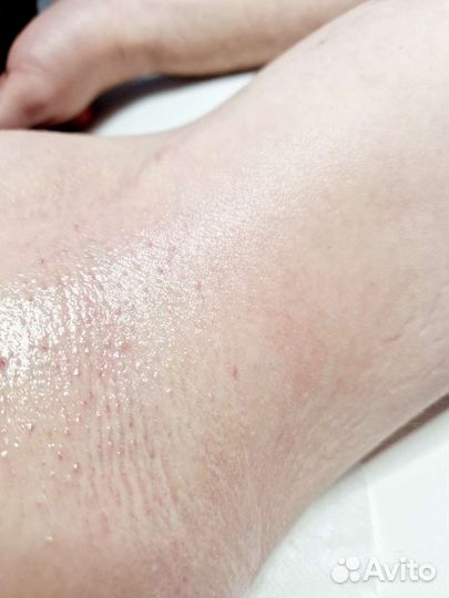 LPG,Коррекция фигуры, Кавитация, Депиляция жд окр