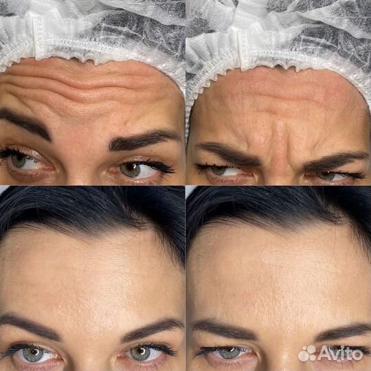 Идеальный ботокс