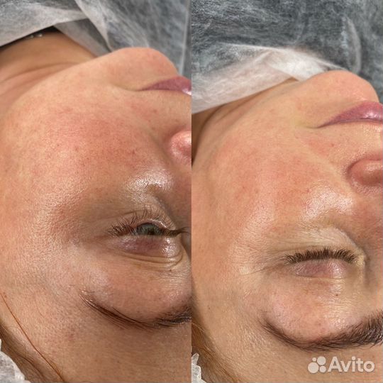 Гидропилинг