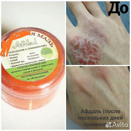 Мазь,крем,лишай, Псориаз, зуд