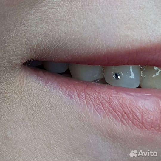 Установка скайсов,твинклов