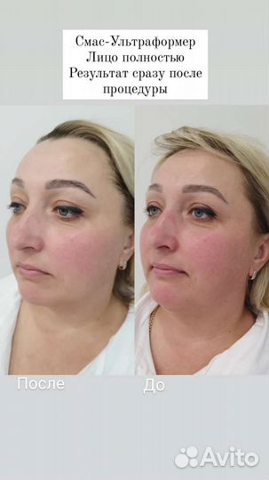 Смас-лифтинг Ультраформер